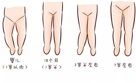 纸尿裤捂住宝宝小屁屁，会导致O型腿？