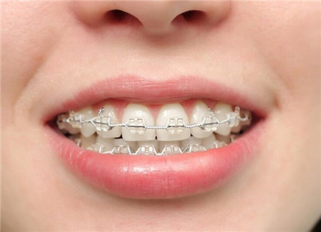 月经期可以矫正牙齿吗 矫正牙齿也要讲究时间