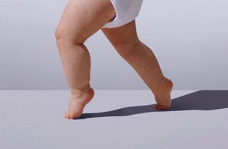 宝宝O型腿如何矫正？家长应该怎么做？