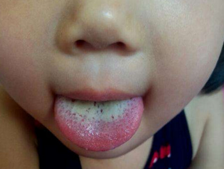 孩子舌苔厚是不是上火