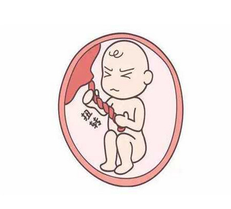 脐带扭转是什么原因