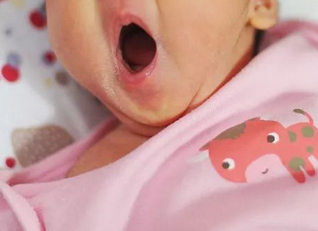 新生儿黄疸需小心该怎么办