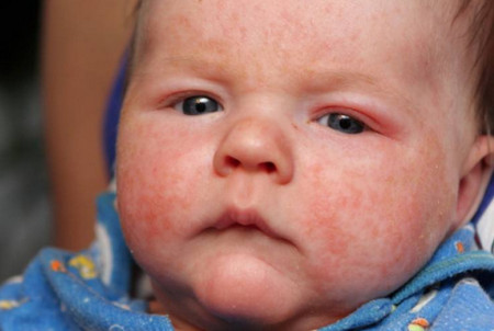 宝宝出现的结膜炎主要有哪些症状？
