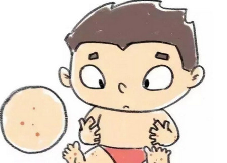 小儿过敏性紫癜能运动吗