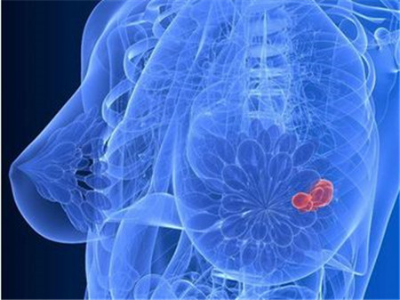 乳腺癌的早期症状是什么