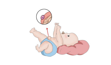 宝宝脐带掉了之后肚脐凸出来了是怎么回事
