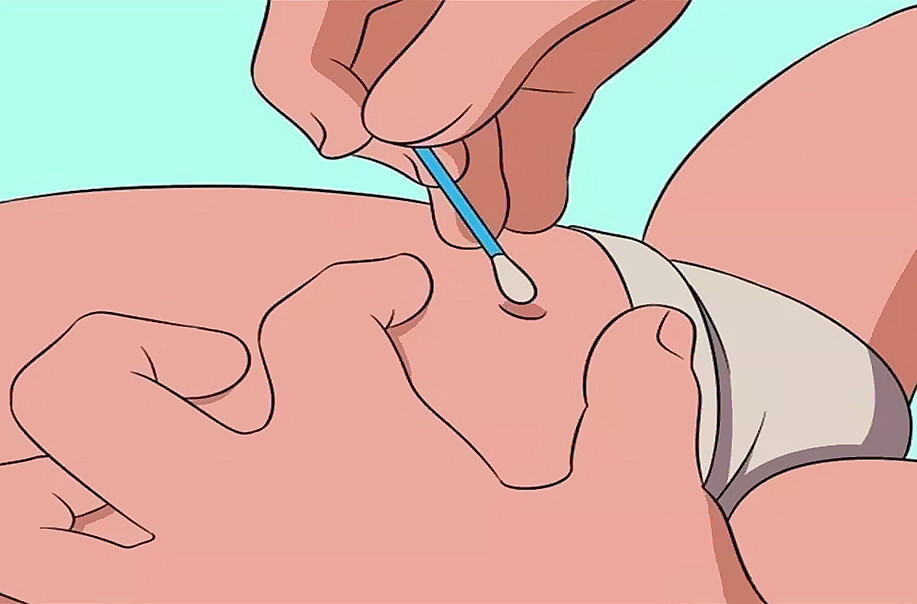 新生儿脐带感染怎么预防