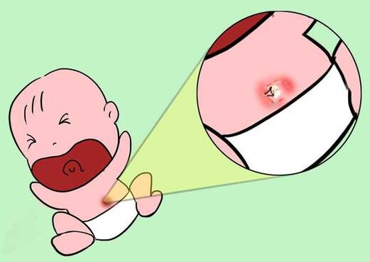 新生儿脐带流水是怎么回事