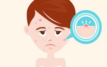 宫寒额头长痘痘吗