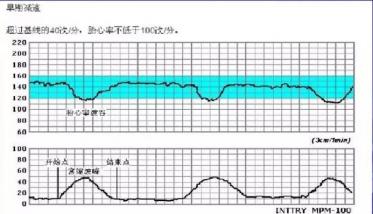 胎心监护胎心减速的三种曲线