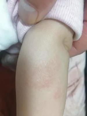 婴儿湿疹反反复复怎么根除 亲亲宝贝网