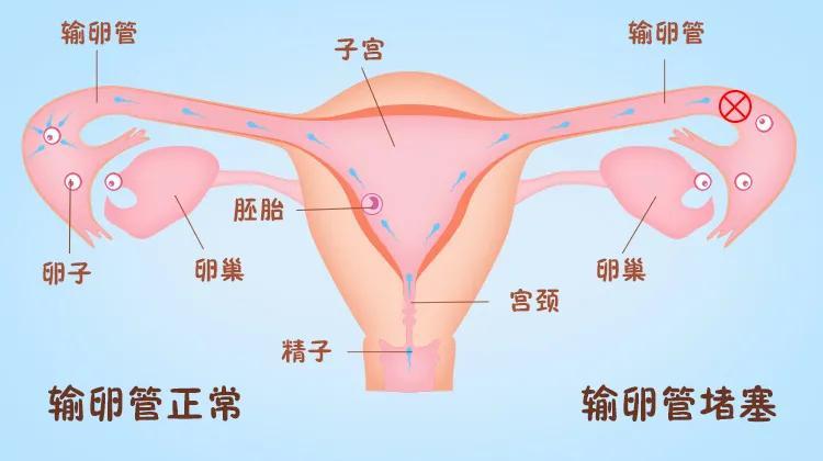 碘油造影对输卵管助孕作用