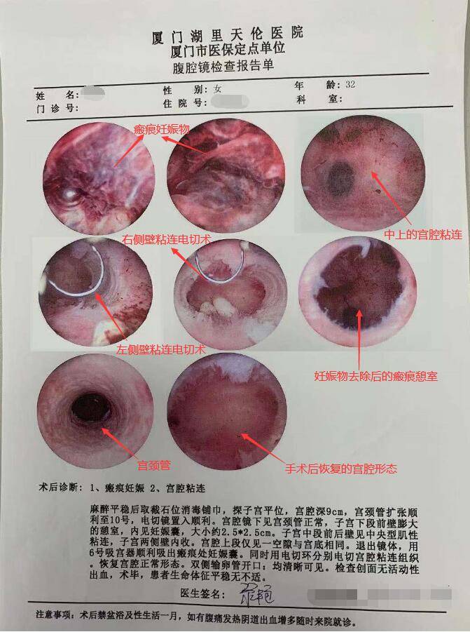 廈門天倫醫院黎豔主任宮頸粘連分離手術案例分享