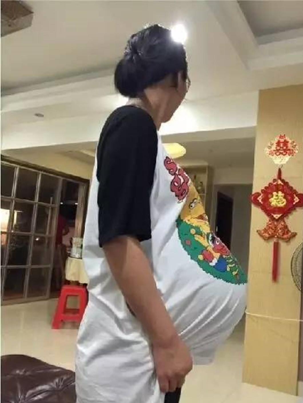 孕妇"悬垂肚"走红,旁人纷纷猜测是双胞胎,医生:大家误解了