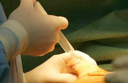 详述剖宫产手术前的准备工作