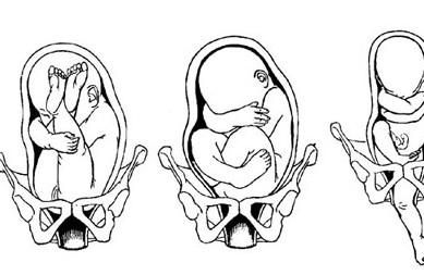 这4种不良胎位会造成难产