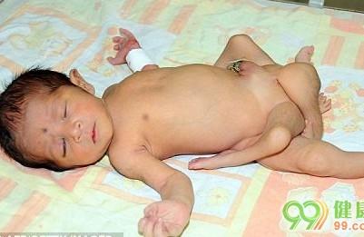 巴基斯坦一名婴儿长出6条腿