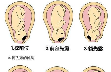 哪些情况才属于胎位不正