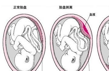 什么是前置胎盘以及它的种类