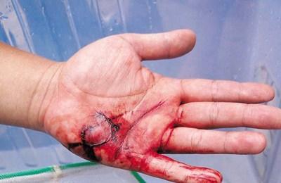 广西食人鱼连袭2人 伤者手掌血肉模糊