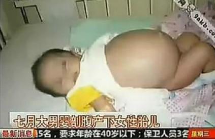 男婴剖腹产下女性胎儿是真的吗