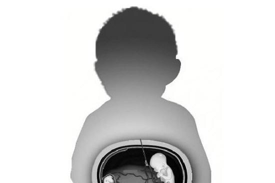 男婴剖腹产女惊骇双亲 原来是寄生胎在作怪