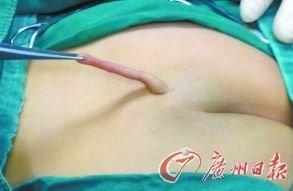女婴屁股上为什么长尾巴？隐性脊柱裂还是返祖？
