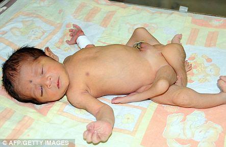 巴基斯坦现6条腿婴儿，系严重遗传疾病