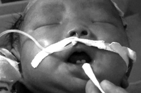 孕妇过度补钙 女婴出生长两颗门牙