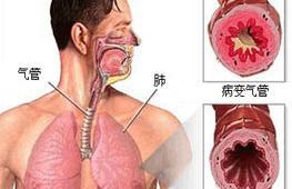 咳嗽变异性哮喘病主要表现症状