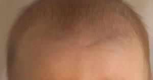 春季婴幼儿常见病  过敏性哮喘