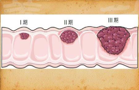 结肠癌会遗传吗