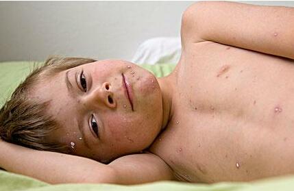 幼儿急疹与风疹的区别
