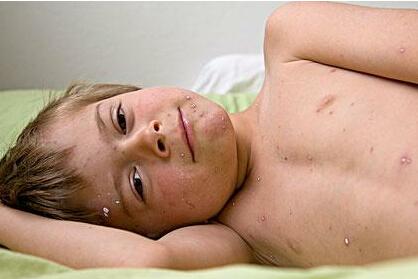 幼儿急疹与风疹的区别