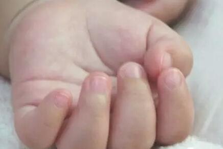 宝宝指甲扁平是什么原因