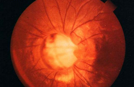 早产儿视网膜病变能治好吗