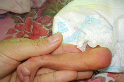 新生儿硬肿症的症状