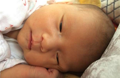 新生儿生理性黄疸多久可以消退