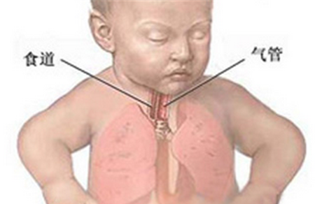新生儿肺不张的原因