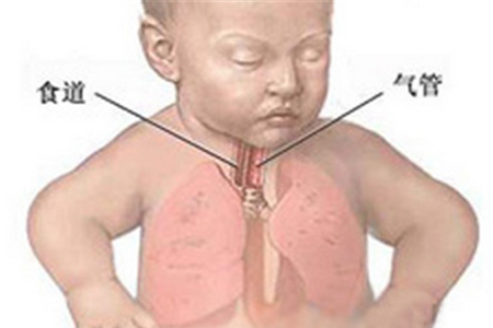 新生儿肺不张的原因