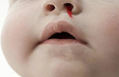 血友病是什么 婴幼儿血友病常见问题