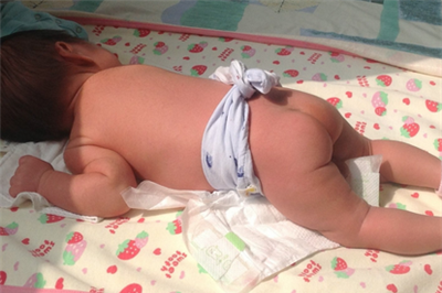 新生儿黄疸怎么晒太阳