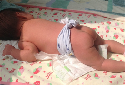 新生儿黄疸怎么晒太阳