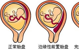 胎盘距宫颈口多少正常？