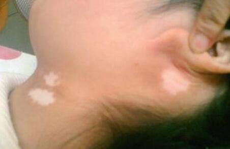 儿童白色糠疹的症状是什么样子  冬春高发，要小心！