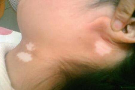 儿童白色糠疹的症状是什么样子  冬春高发，要小心！