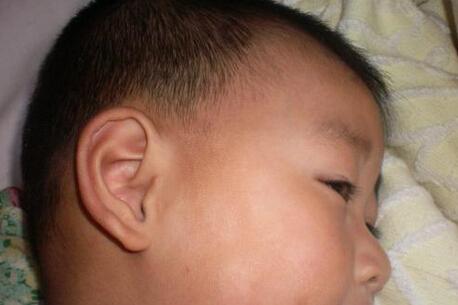 儿童白色糠疹是什么原因导致的 宝宝日常容易忽略的三大点