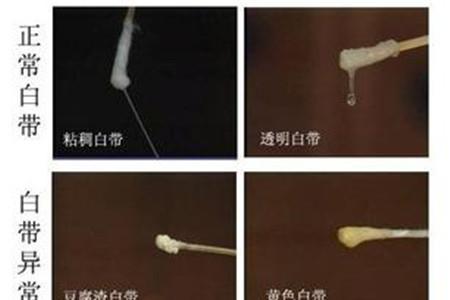 早孕白带会有什么变化 孕妇妈妈需早了解