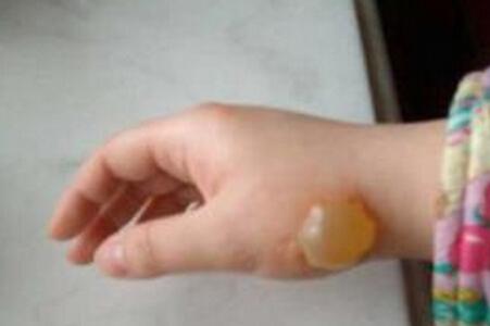 宝宝烫伤有水泡怎么办 正确护理最重要