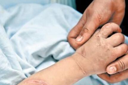 宝宝烫伤多久会好 如何正确护理可加快愈合？